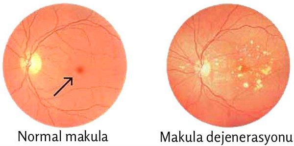 Sarı nokta olarak da bilinen makula, görme işleminde büyük rol oynar, zarar görmesi durumunda da görme problemlerine yol açan makula dejenerasyonu meydana gelir.