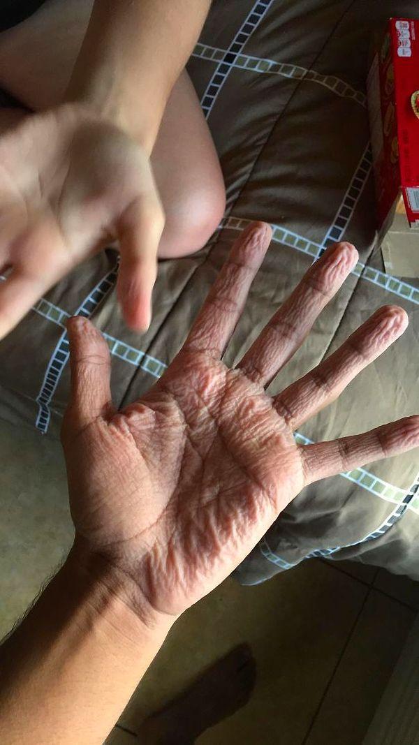 27. "Abnormally Pruney Fingers?? Every Time I Go Swimming With Anyone My Hands Are Always 10x More Wrinkly Than Anyone Else’s"