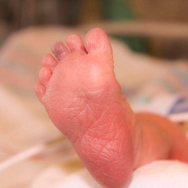 30. "Here Is An Example Of Ryder’s Polydactyly"