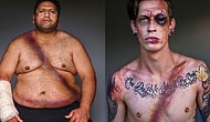 Car Crash Survivors Pose With Seatbelt Wounds To Raise Awareness About Seatbelt Safety!