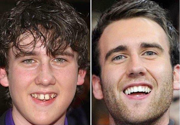 17. Harry Potter'da Neville Longbottom karakteriyle tanıdığımız Matthew Lewis; yıllar içinde hem kilo verdi, hem de dişlerini değiştirdi.
