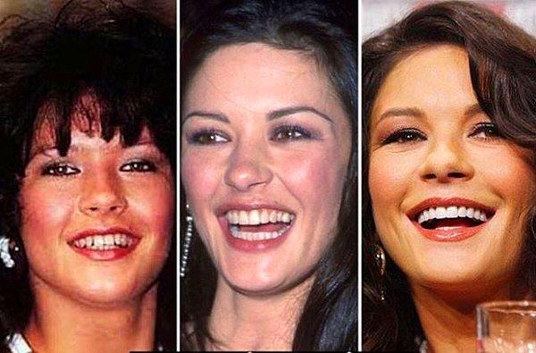 20. Catherine Zeta-Jones önce tel tedavisi, daha sonra da Hollywood gülüşü denen estetik uygulamayı yaptırdı.