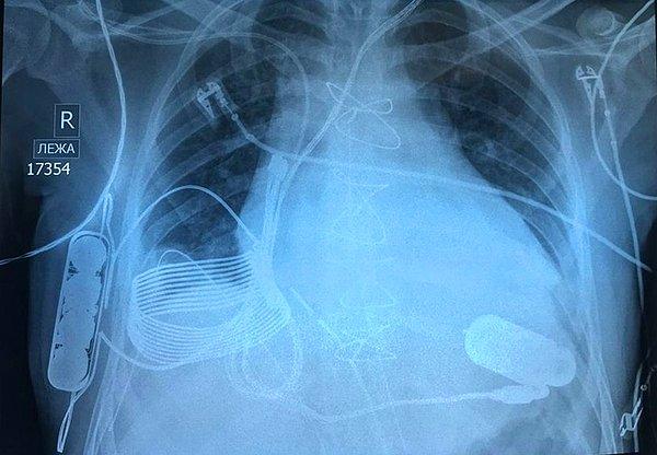 12. Göğüs röntgeninde görünen kablosuz şarj olabilen biyonik kalp: