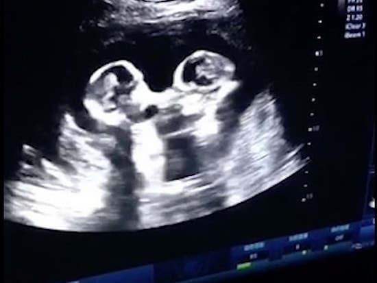 Anne Karnında Birbirlerini Yumruklayan İkiz Bebekler