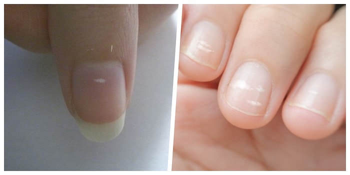 Tırnak Üzerinde Oluşan Beyaz Lekelerin Neden Oluştuğunu Biliyor musunuz?