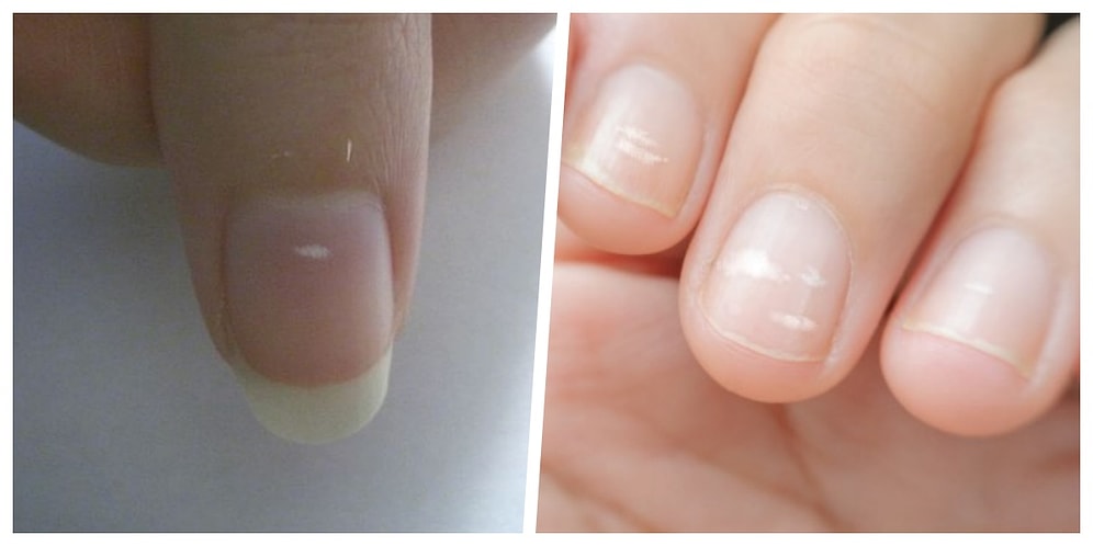 Tırnak Üzerinde Oluşan Beyaz Lekelerin Neden Oluştuğunu Biliyor musunuz?