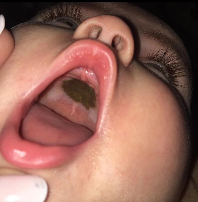 Bebeğinin damağında gizemli siyah bir iz gören anne doktorların yanıtıyla şoke oldu