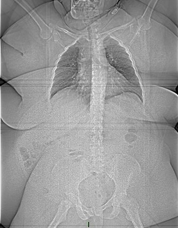 11. 185 kiloluk bir hastanın röntgeni: