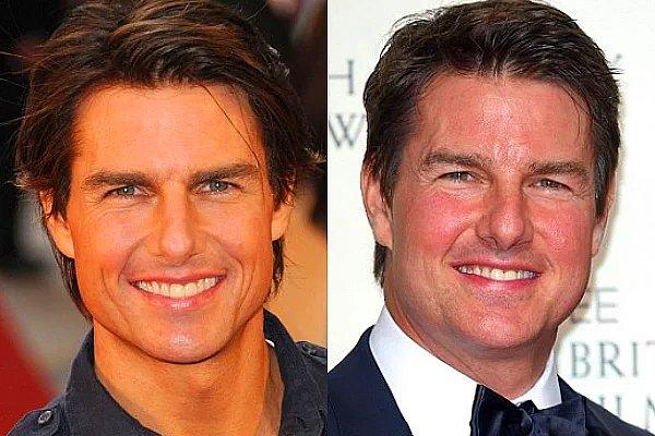 13. Tom Cruise'un yüzünün ortasındaki abartılı şişlik, yapılan işlemin bir dolgu olduğunu gösteriyor.