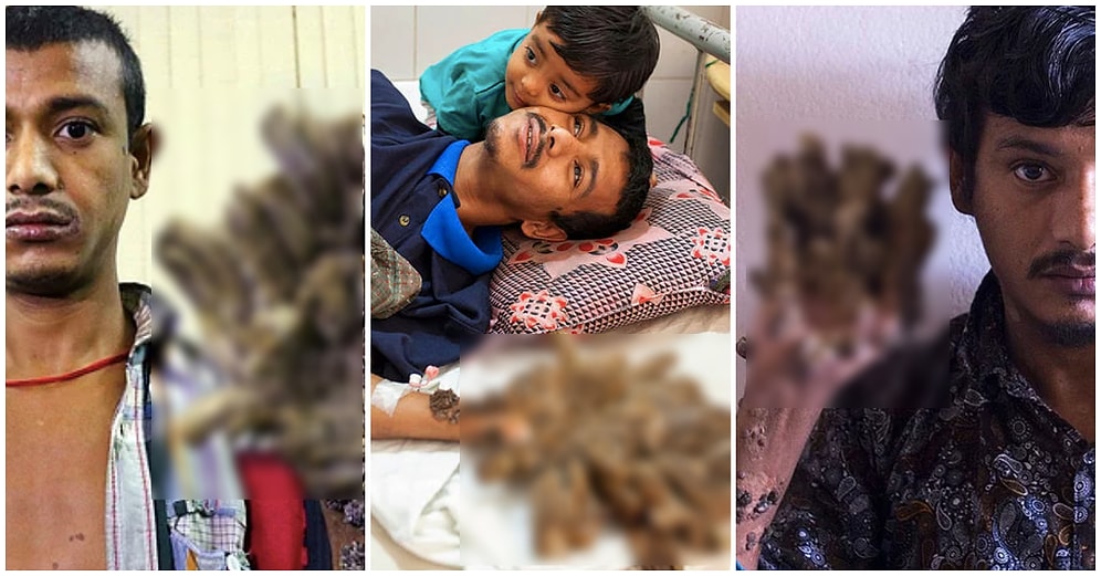 Bangladeşli 'Ağaç Adam' Çektiği Acılara Daha Fazla Katlanamadığı İçin Ellerinin Kesilmesini İstiyor