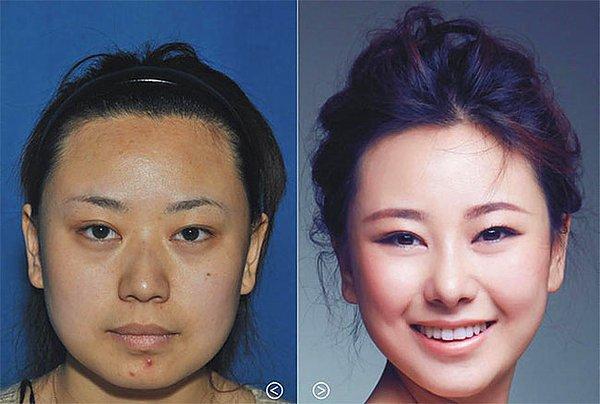 10. Estetik burun ameliyatı, çene implantı, yağ aldırma, botoks ve saç ekimi tedavisinden önce ve sonra: