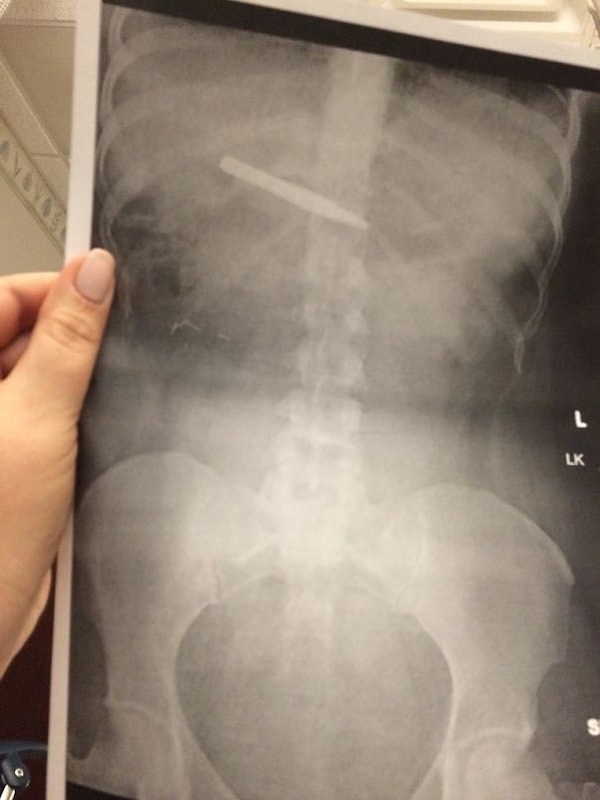 16. «Моя ненаглядная проглотила щипчики для бровей»