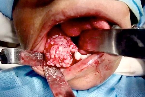 2014 yılında Mumbai'de benzer bir olay yaşandı ve genç yaşlarda bir çocuğun ağzından 232 tane diş çıkarıldı.