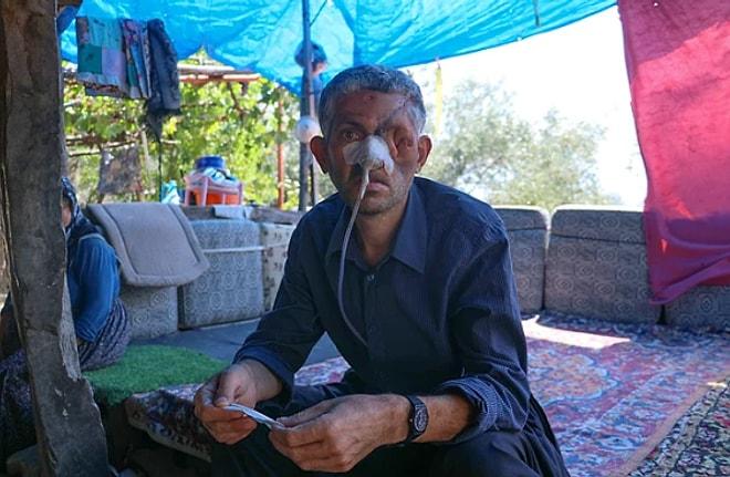 Doktor İhmali mi? Diş Ağrısı Şikayetiyle Gitti, Gözünü ve Yüzünün Bir Kısmını Kaybetti
