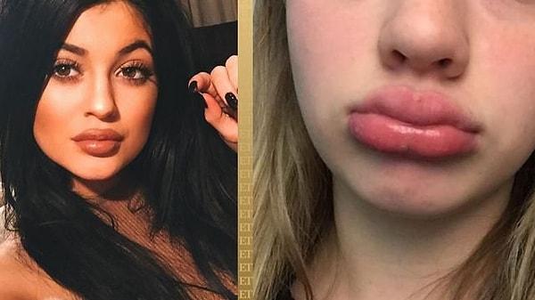 Birkaç yıl önce Kylie Jenner challenge olarak adlandırılan dudak büyütme yöntemi pek çok gencin sağlığına zarar vermişti.