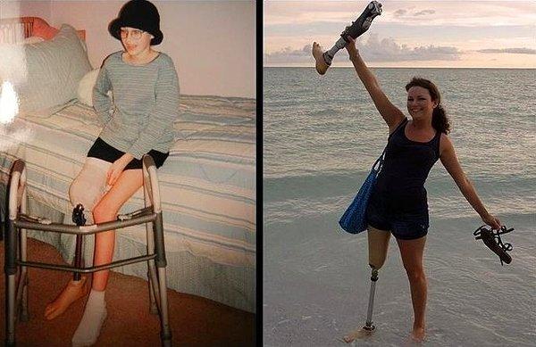2. "Bugün resmen 10 yıldır kansersiz yaşıyorum! İşte ne kadar yol kat ettiğimi gösteren bir önce/sonra fotoğrafı."