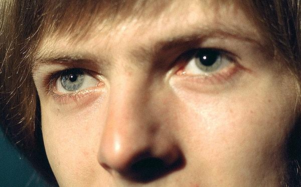 7. David Bowie'nin bir gözü kalıcı olarak görme yetisini kaybetmiş.