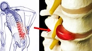 Gencinden Yaşlısına Herkesin Sorunu Haline Gelen Bel Fıtığıyla İlgili Mutlaka Bilmeniz Gerekenler