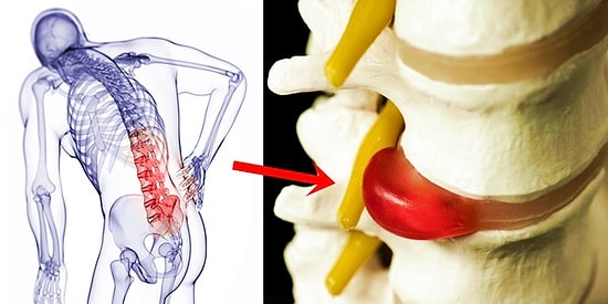 Gencinden Yaşlısına Herkesin Sorunu Haline Gelen Bel Fıtığıyla İlgili Mutlaka Bilmeniz Gerekenler