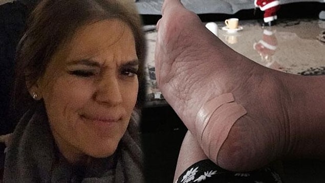 10. Ayakların efendisi Demet Akalın'ın ev kazası sonucu oluşan yaralanma fotoğrafı, peşimizi bırak!
