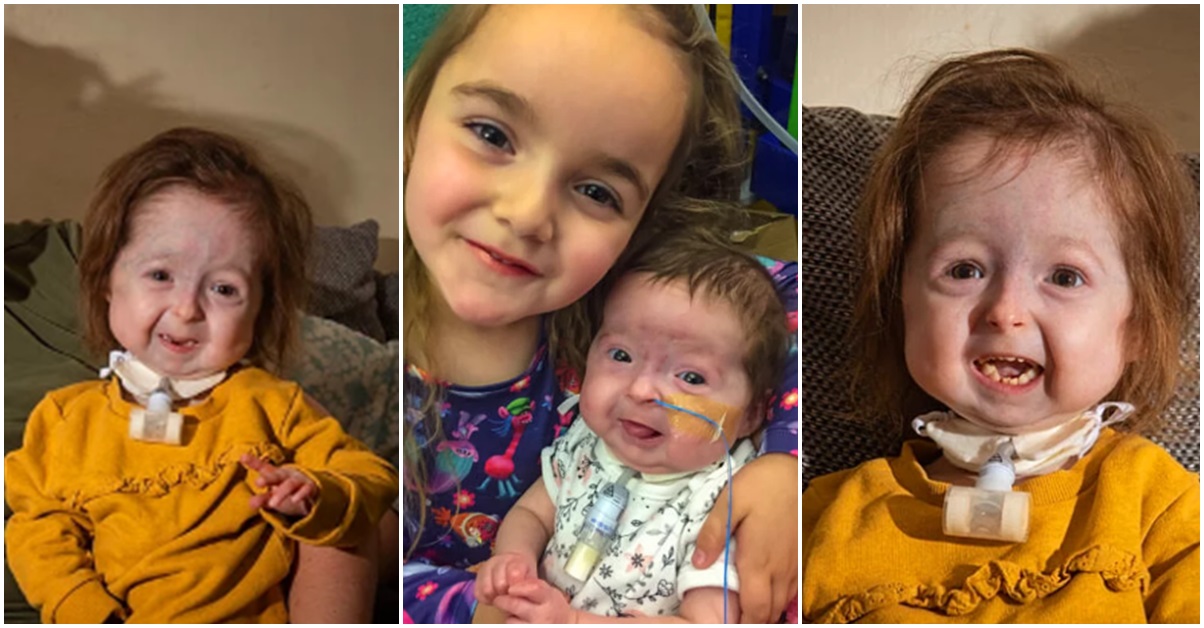 Dünya Üzerinde Sadece 2 Yaşındaki Isla KilpatrickScreaton'ın Sahip