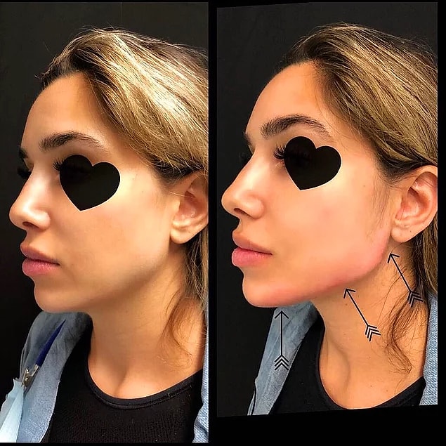 Jawline sonrası bir sıkıntı yaşanıyor mu?