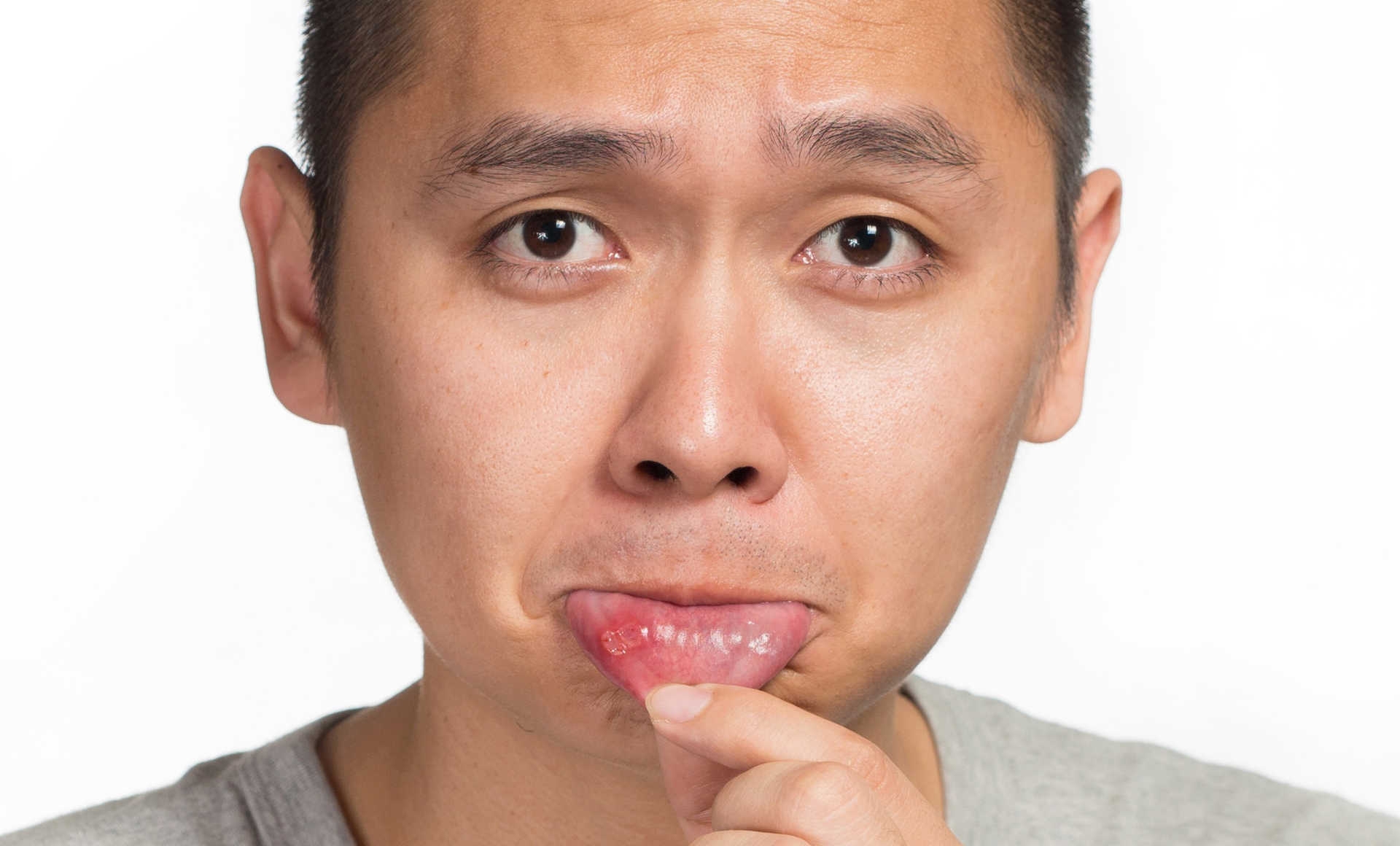 aft nedir nasil olusur aft tedavisi nasil yapilir hangi ilaclar kullanilir