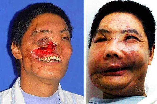12. Bir ayı tarafından yaralanan Li Guoxing, 2006 yılında Çin'de yüz nakli yapılan ilk hasta oldu.