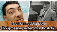 Vücudunuzda Anormal Bir Büyüme Varsa Dikkat! Büyüme Hormonunun Fazla Salgılanmasıyla Oluşan Hastalık: Akromegali
