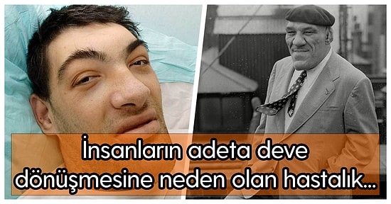 Vücudunuzda Anormal Bir Büyüme Varsa Dikkat! Büyüme Hormonunun Fazla Salgılanmasıyla Oluşan Hastalık: Akromegali