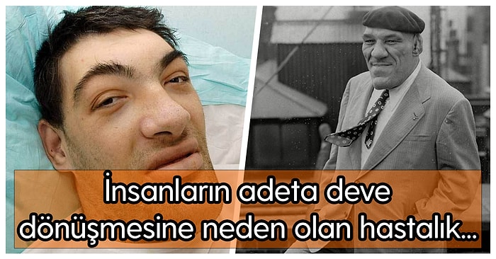 Vücudunuzda Anormal Bir Büyüme Varsa Dikkat! Büyüme Hormonunun Fazla Salgılanmasıyla Oluşan Hastalık: Akromegali