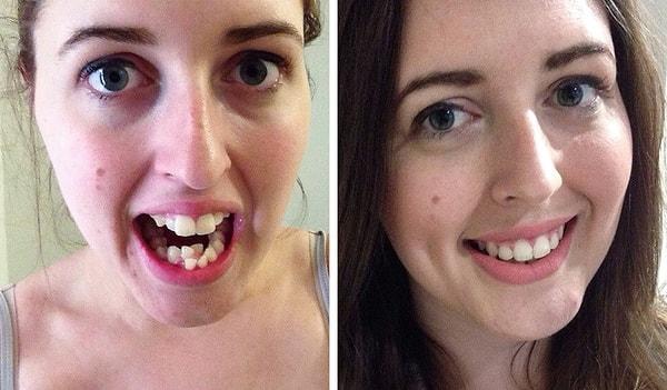 8. "Dün diş tellerim çıktı, öncesi ve sonrası fotoğrafım."