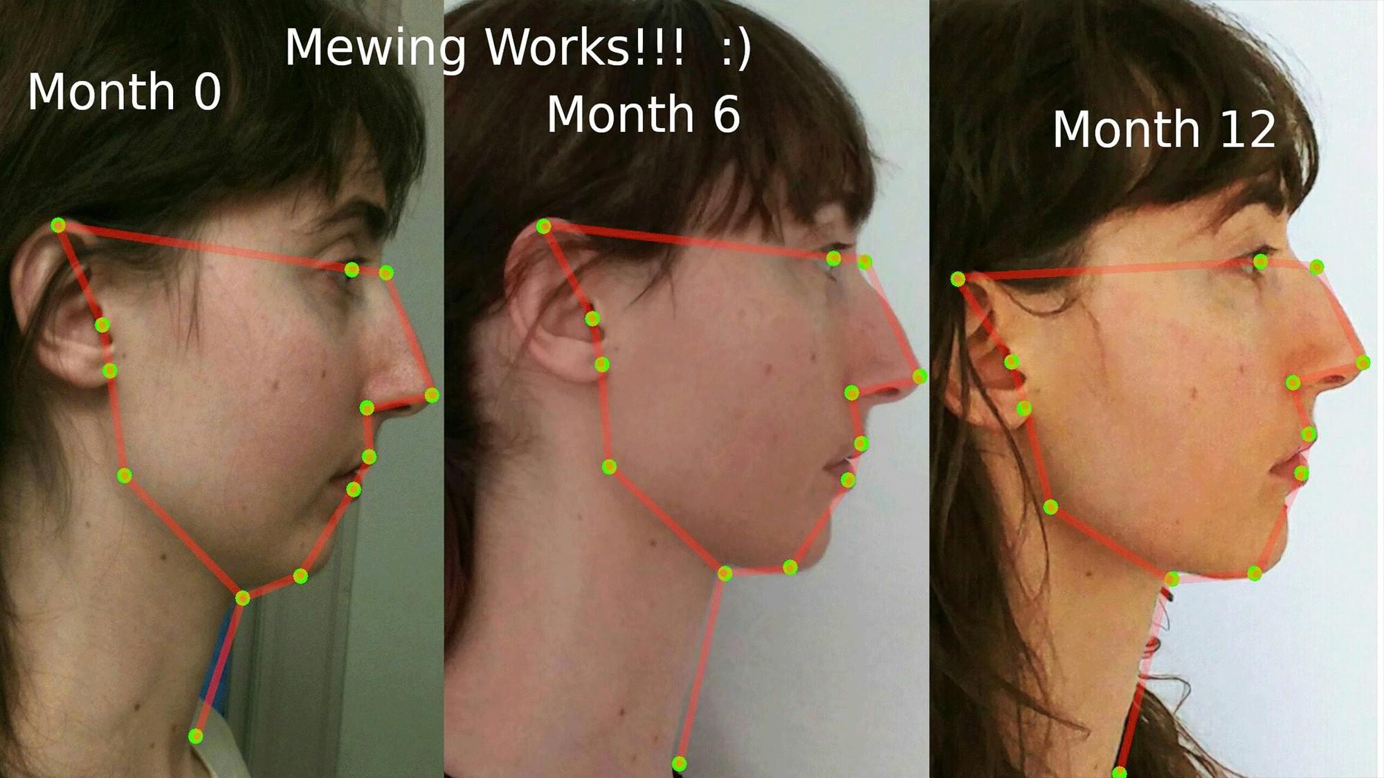 Что означает мьюнинг. Максилла Мьюинг. Mewing до и после. Коррекция подбородка. Мьюинг упражнения для лица.