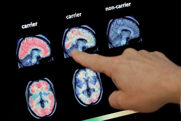 Bu çalışmada, belirtiler henüz görülmeden önce ilaç tedavisine başlanacak olursa Alzheimer hastalığının önüne geçilebilir mi sorusuna yanıt aranıyordu.