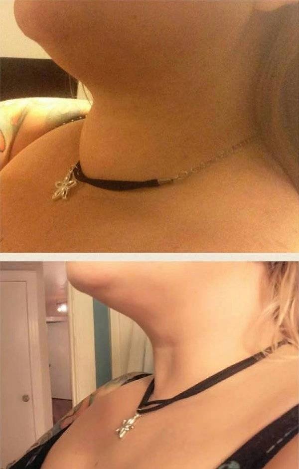 12. Шея до и после удаления зоба щитовидной железы