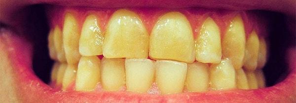 Uygulama sonrası dişlerin sararması normal mi?