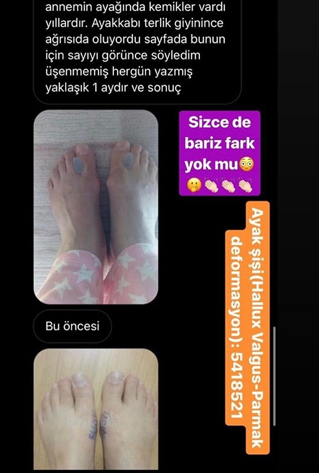 Ayrıca direkt sorunlu bölgenin üzerine yazıldığında da etkili sonuç alındığı söyleniyor.