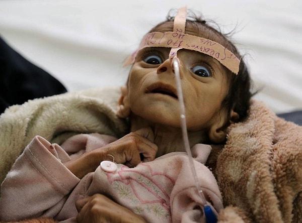 4. Örneğin Yemen'de şu an 12.3 milyon çocuğun yardıma ihtiyacı var.