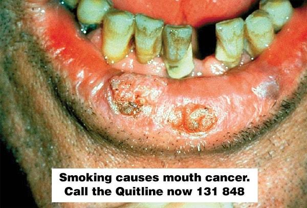 2. Sigara içmek sadece akciğer kanserine değil, ağız kanserine de neden olur...