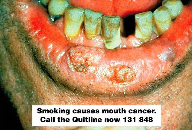 2. Sigara içmek sadece akciğer kanserine değil, ağız kanserine de neden olur...