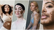 Çektiği Karelerle Vitiligo Hastası Kadınların Güzellik Kalıplarını Yıktığını Kanıtlayan Yetenekli Fotoğrafçı Elisabeth Van Aalderen ile Tanışın!