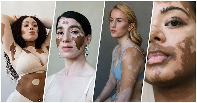 Çektiği Karelerle Vitiligo Hastası Kadınların Güzellik Kalıplarını Yıktığını Kanıtlayan Yetenekli Fotoğrafçı Elisabeth Van Aalderen ile Tanışın!