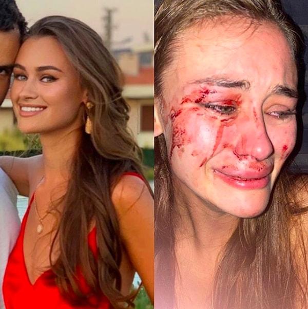 1. Ukraynalı model Daria Kyryliuk, tatil için geldiği İzmir Çeşme’deki “The Beach of Momo” isimli işletmenin güvenliği tarafından darp edildiğini iddia etti.