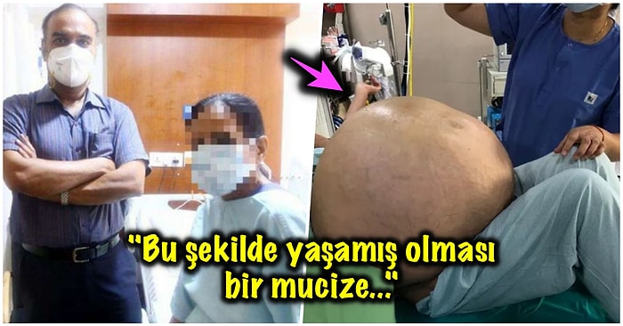 Karın Ağrısı Şikayetiyle Gittiği Hastanede Karnından 50 Kiloluk Dünyanın En Büyük Tümörü Çıkan Kadın