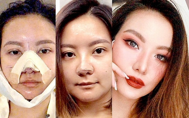 Ancak insanların estetik operasyonlara yönelmesinin en büyük sebebi iyileşme süresi.