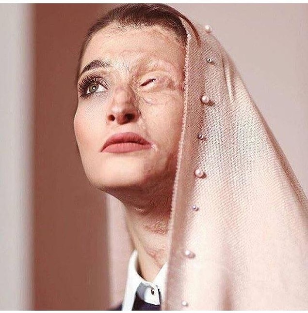 Saldırganlar Marziyeh'nin düzgünce örtünmediğine karar veriyor ve bu güzel kadın daha hayatının baharındayken asit saldırıyla karşı karşıya kalıyor.