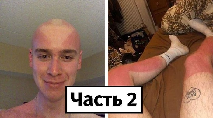 Самая горячая подборка неудачного загара этого лета, или 20 случаев, когда люди забыли нанести солнцезащитный крем (Часть 2)