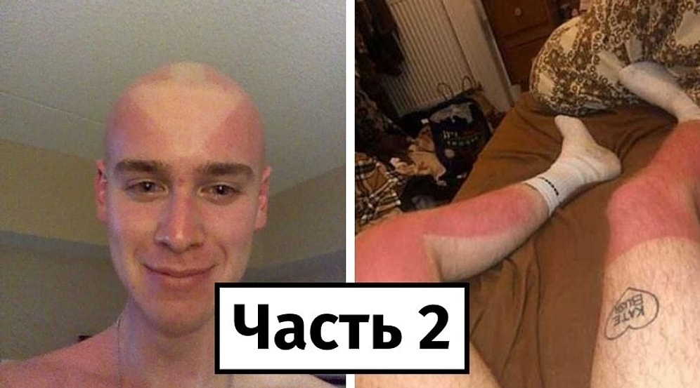 Самая горячая подборка неудачного загара этого лета, или 20 случаев, когда люди забыли нанести солнцезащитный крем (Часть 2)
