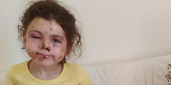 5 yaşındaki Neriman Bulut, yüzüyle birlikte vücudunun çeşitli yerlerinden saçmayla yaralandı.