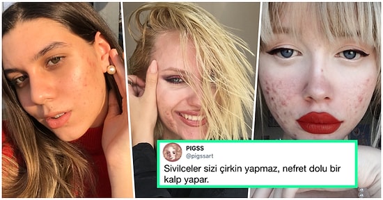 Onları Kusur Olarak Görüp Kapatmak Yerine Sivilceleriyle Barışıp Mutlu Bir Hayat Sürmeye Yemin Etmiş 15 Kişi